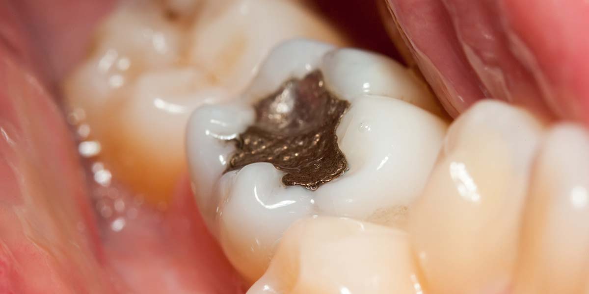 mercury dental amalgam filling